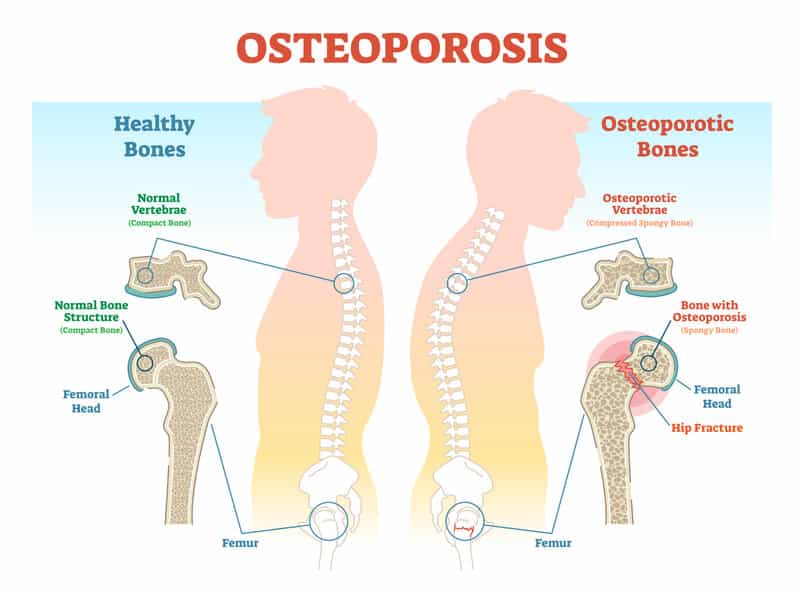 Osteoporosis causes and treatments