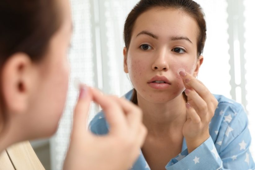 Pimple patches for acne spot treatment