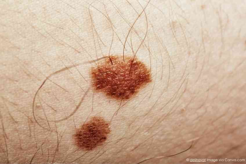 Hairs from moles can be used for hair regrowth in other parts of the body