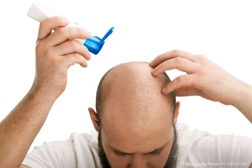 The Battle Against Balding