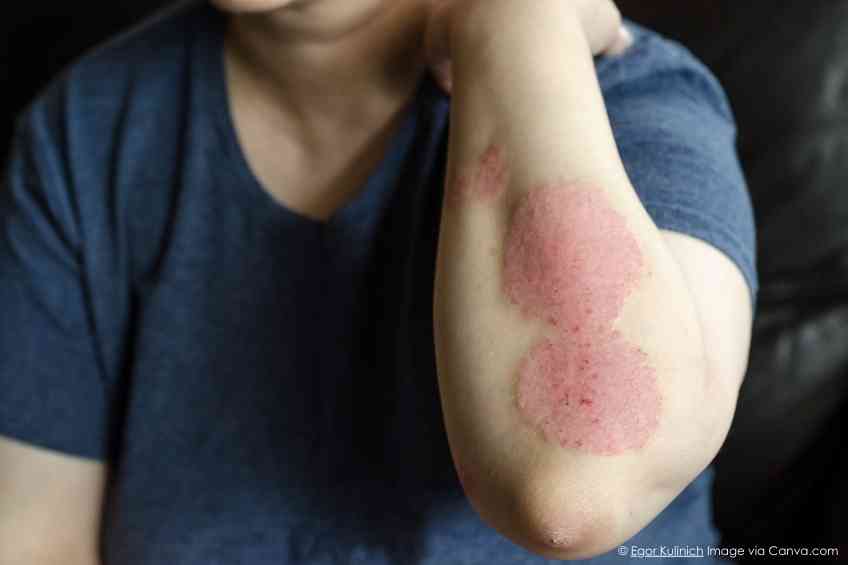 Diet May Reduce Psoriasis Severity